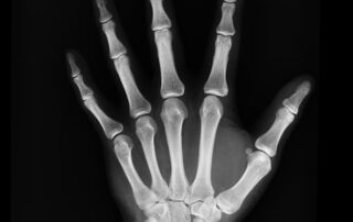 Hand therapy in Edison, NJ