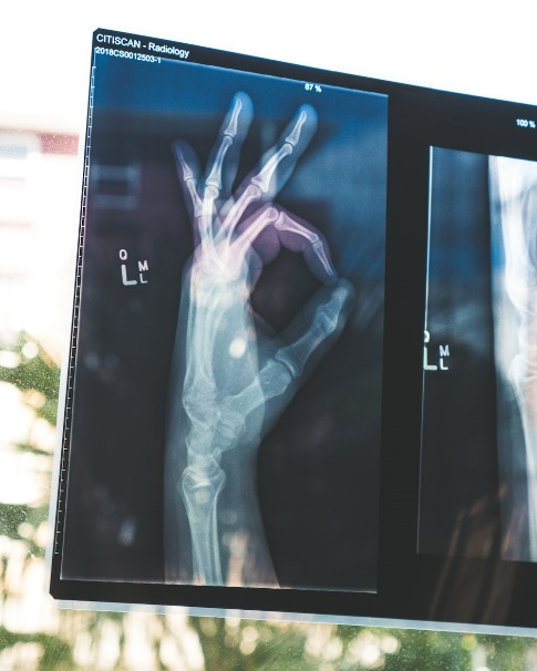 Xray of a hand